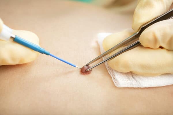 removing a mole, Hyfrecator® treatments