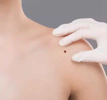 skin tag treatment