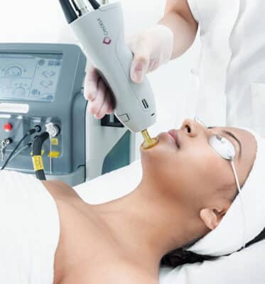 candela laser hair removal