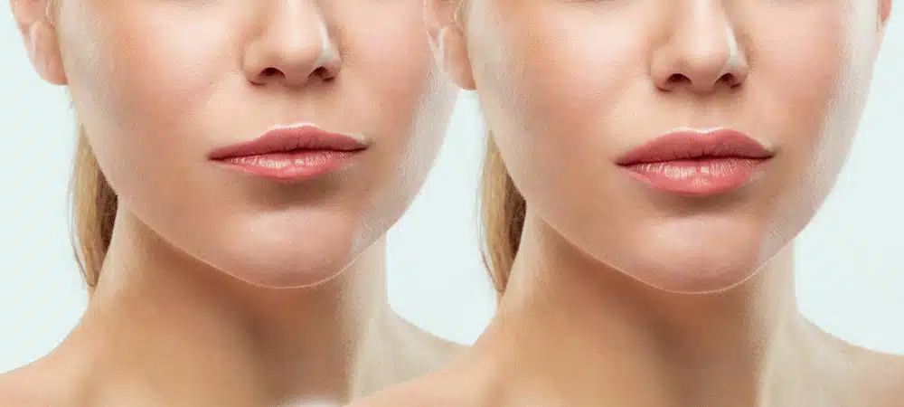 Vida Aesthetics Botox Madison WI | Fillers | Moxi Laser