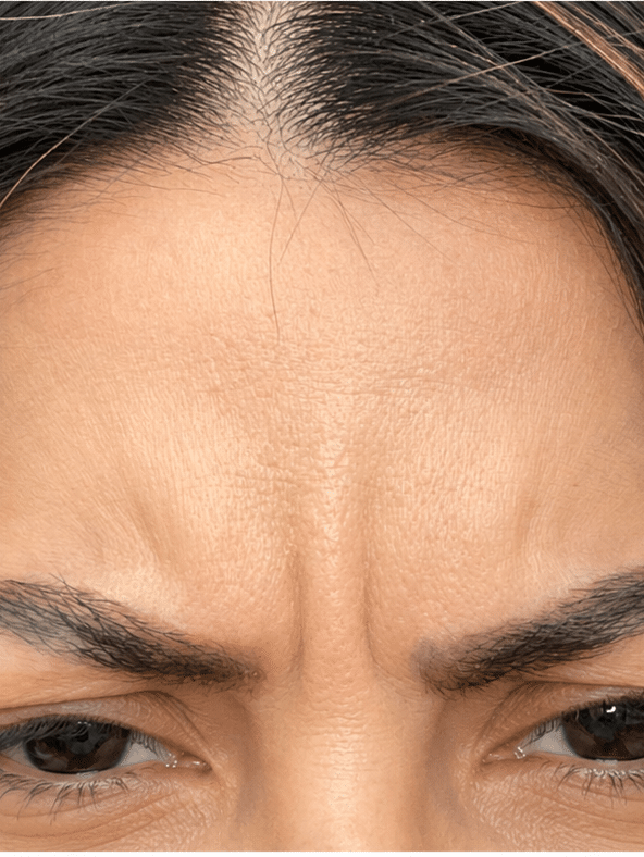 Vida Aesthetics Botox Madison WI | Fillers | Moxi Laser