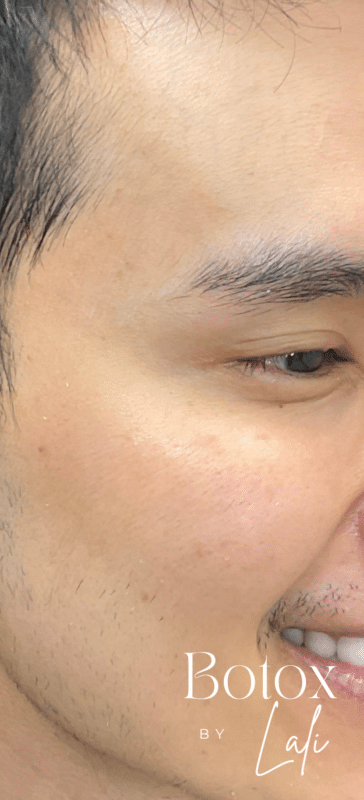 Vida Aesthetics Botox Madison WI | Fillers | Moxi Laser